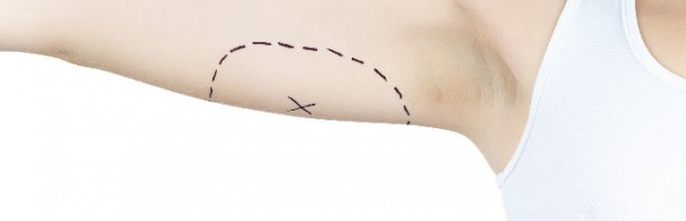 Braquioplastia: Todo lo que necesitas saber de la cirugía de brazos